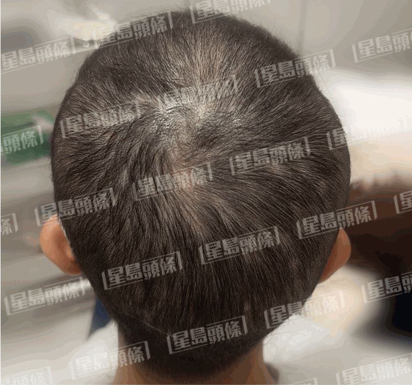 脫髮女子治療三個星期後的進度，頭髮亦慢慢開始生長。（相片由註冊中醫師陳嬿珺提供）