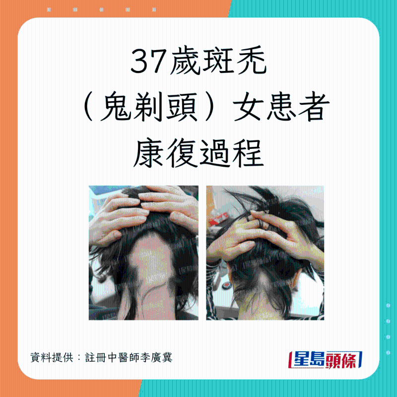 37歲斑禿(鬼剃頭)女患者康復過程