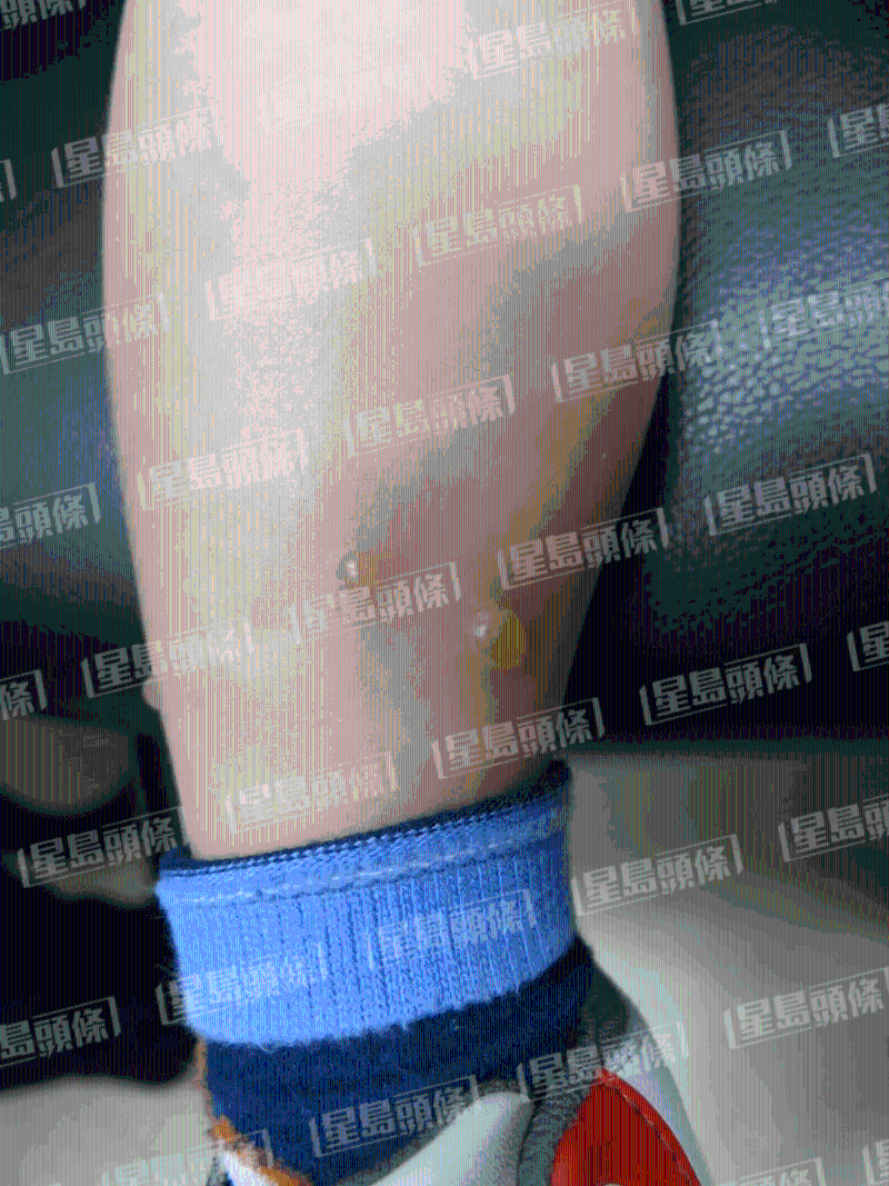 蚊叮蟲咬｜5歲患者被蚊蟲叮咬后長出水泡，最終出現疤痕組織增生長出肉芽。（相片來源：陳厚毅醫生提供）