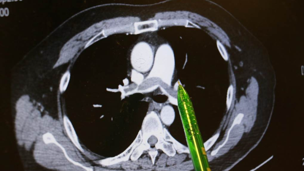 病人肺部兩側大片彌漫的血栓。