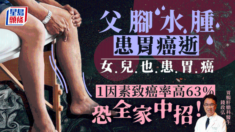 父腳水腫患胃癌逝，女兒也中招，1因素致癌率高63%恐傳染全家