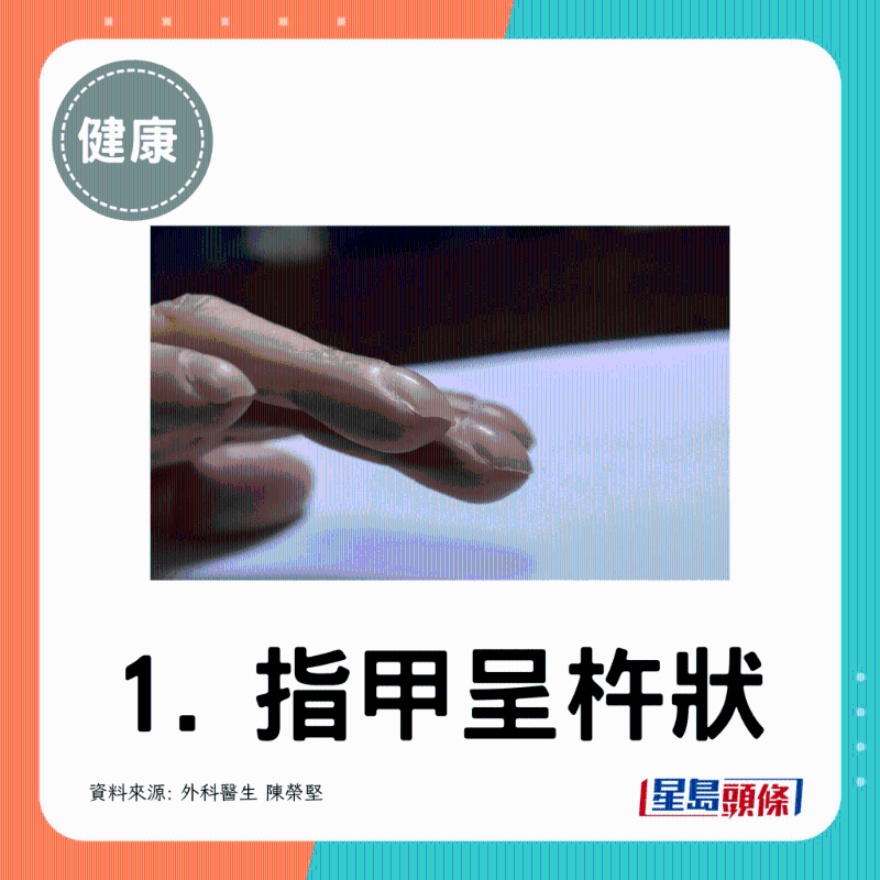 指甲呈杵狀 指甲呈杵狀