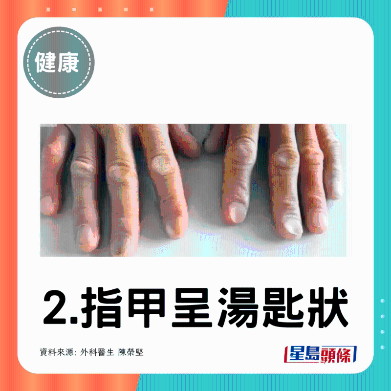 指甲呈湯匙狀(湯匙甲) 指甲呈湯匙狀(湯匙甲)