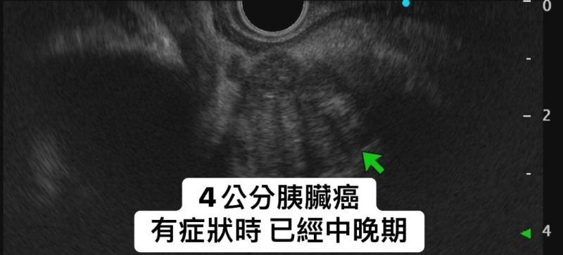 中晚期胰臟癌 中晚期胰臟癌