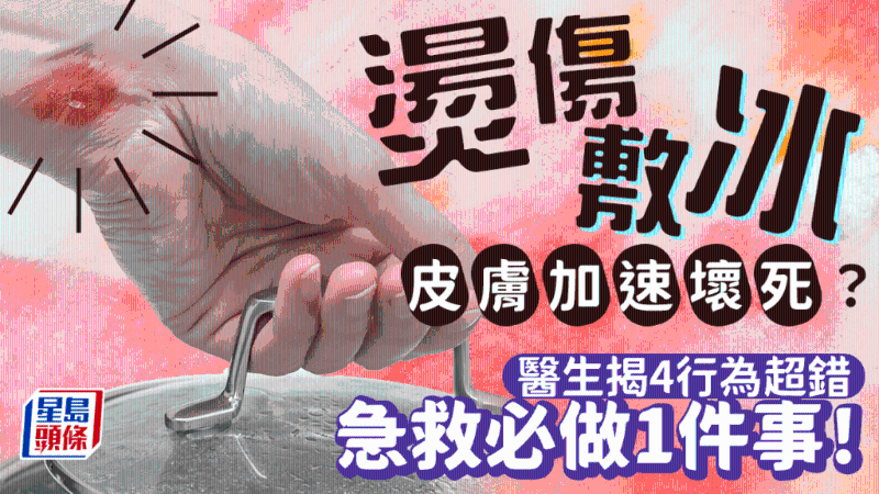 燙傷立即敷冰超錯 燙傷立即敷冰超錯