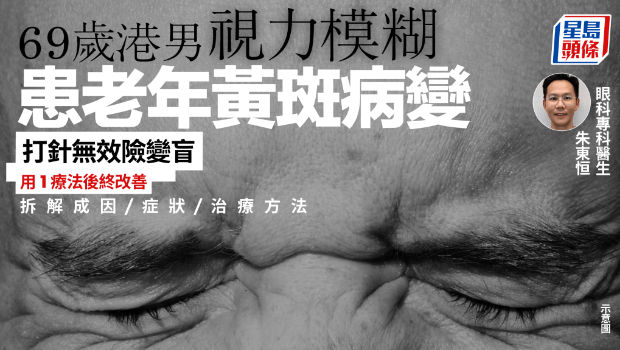 69歲港男視力模糊 69歲港男視力模糊