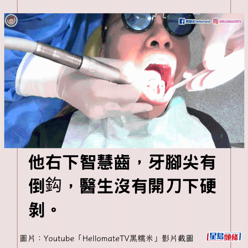 香港男子實測深圳平價洗牙種牙15 香港男子實測深圳平價洗牙種牙15