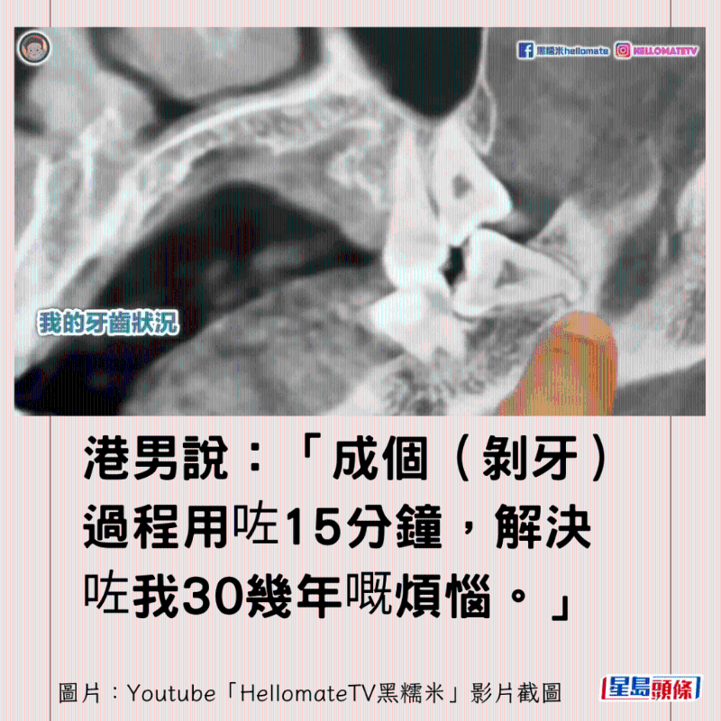 香港男子實測深圳平價洗牙種牙12 香港男子實測深圳平價洗牙種牙12