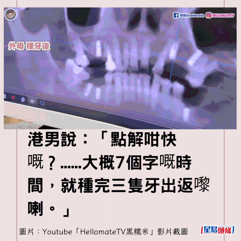 香港男子實測深圳平價洗牙種牙8 香港男子實測深圳平價洗牙種牙8
