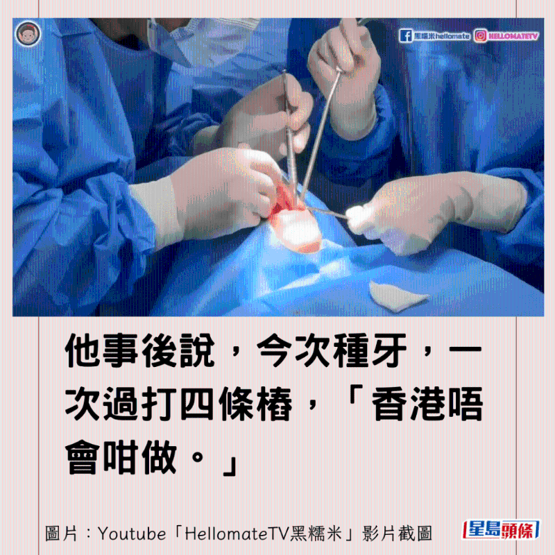 香港男子實測深圳平價洗牙種牙4 香港男子實測深圳平價洗牙種牙4