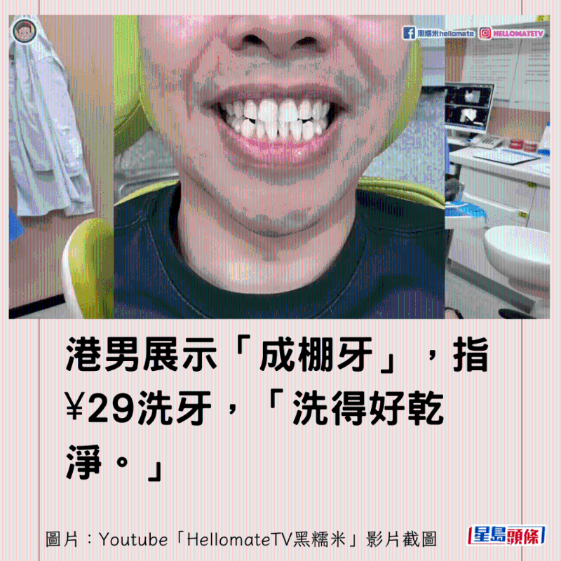 香港男子實測深圳平價洗牙種牙3 香港男子實測深圳平價洗牙種牙3
