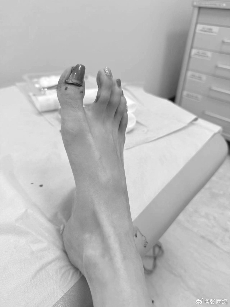 “星女郎”張雨綺坐輪椅代步6 “星女郎”張雨綺坐輪椅代步6