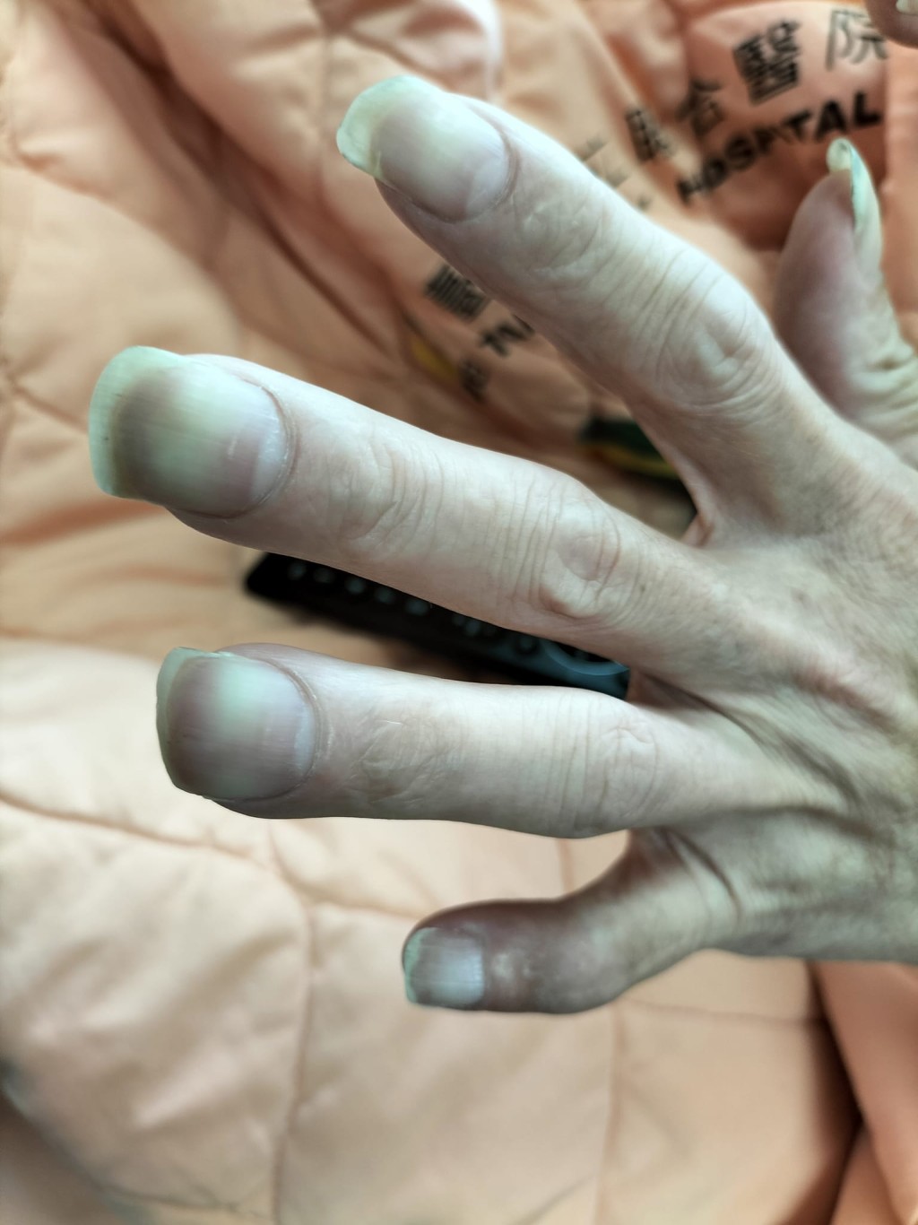 “杵狀指” “杵狀指”