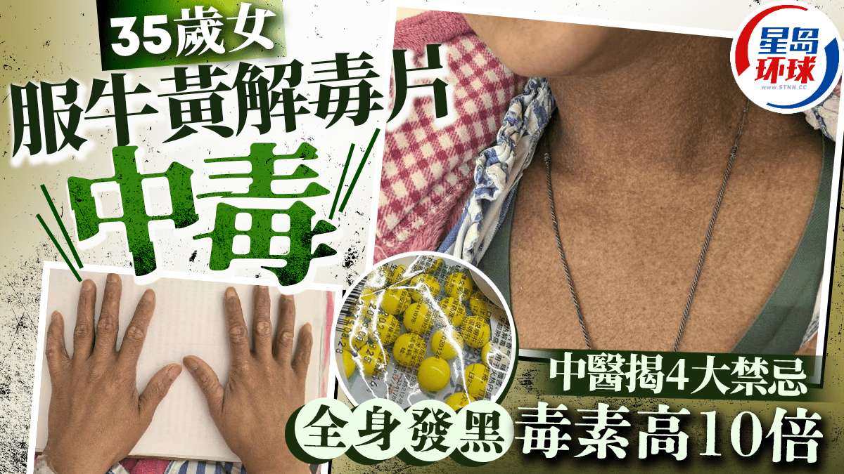 35歲女服牛黃解毒片“砒霜中毒” 35歲女服牛黃解毒片“砒霜中毒”