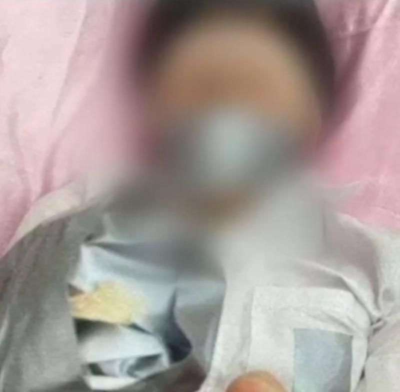 男童尾指遭割斷。 男童尾指遭割斷。